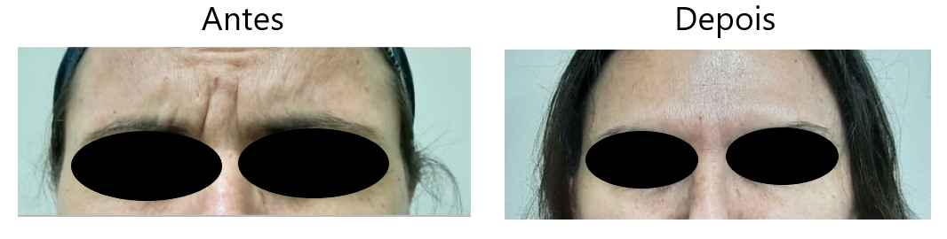 CLIENTE DRA ROSANNE BOTOS ANTES E DEPOIS COM TARJA